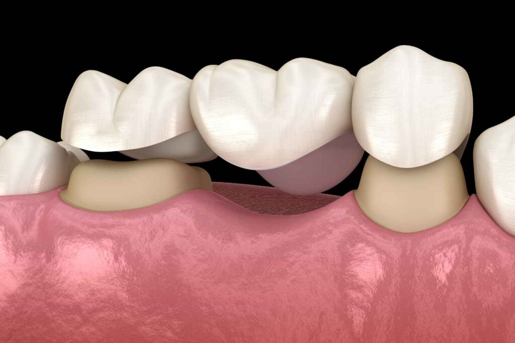 Dental Bridge