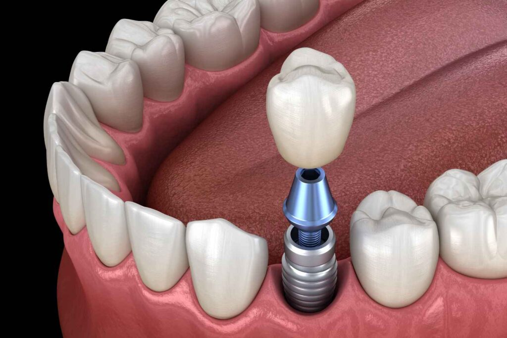 Dental Implant